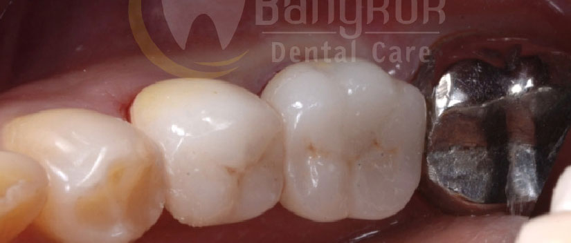 After-Dental Crown